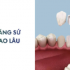 Bọc răng sứ bao lâu thì xong